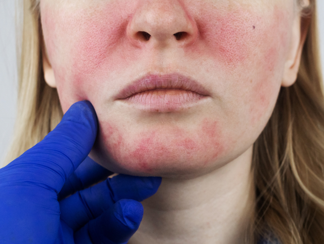 Rosacea-2